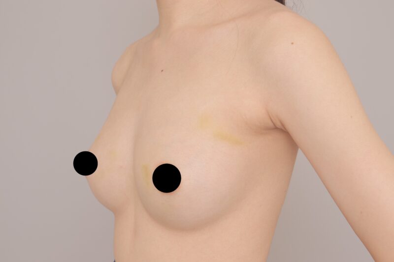 細身でもしっかり変化！太ももから脂肪採取でB→Dカップへ✨“細身巨乳”が叶った脂肪豊胸