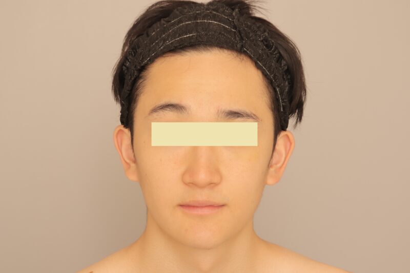 ベイザー脂肪吸引（３ヶ月経過：23）の術後写真