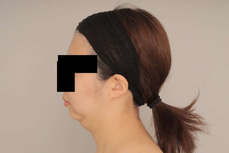 ベイザー脂肪吸引(6か月経過:29)の術前写真