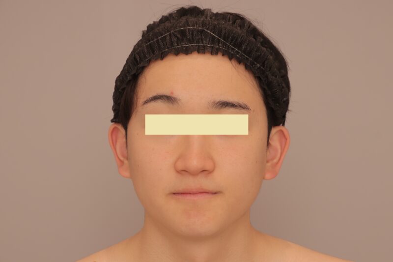 ベイザー脂肪吸引（３ヶ月経過：23）の術前写真