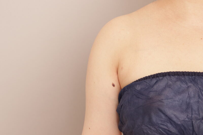 二の腕を細くするには