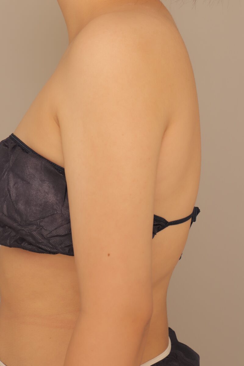 上腕全周の脂肪吸引でしっかり細く！モニター様3ヶ月後♡