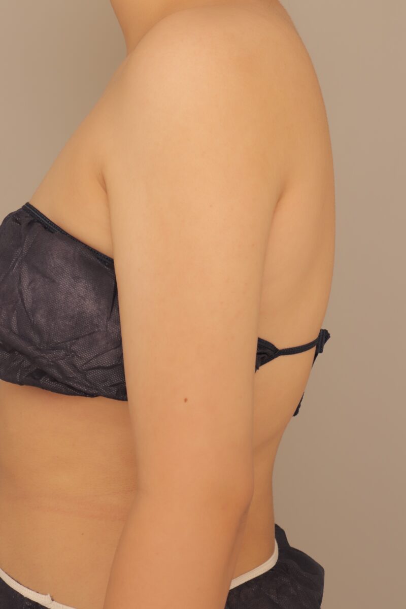 上腕全周の20代モニター様劇的に3ヶ月後♡