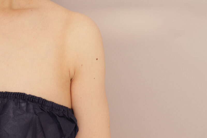 華奢な上半身に脂肪吸引で