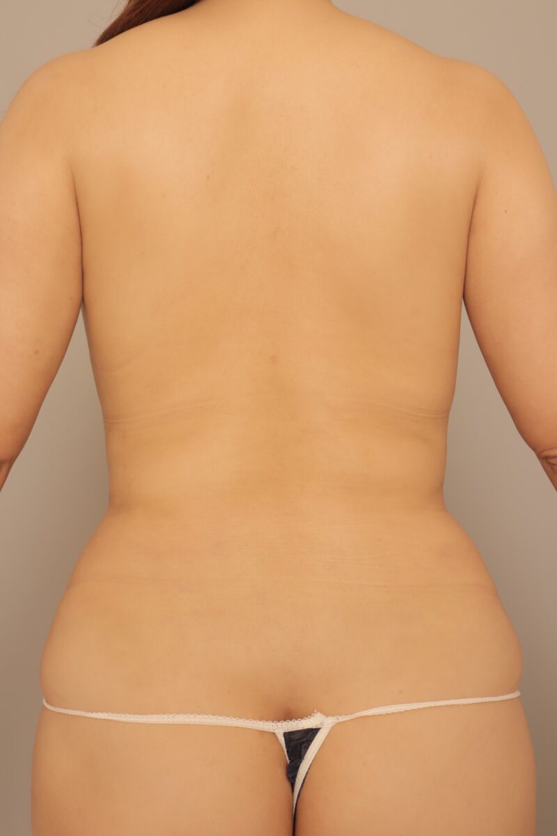 背中に悩む女子たちへ♡1ヶ月でこの変化♪肩甲骨上下腰の脂肪吸引1ヶ月後