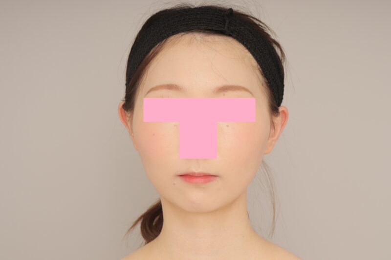 頬顎下脂肪吸引で更に小顔に! モニター様の6か月経過をご紹介♪ 26歳 167cm 55kg