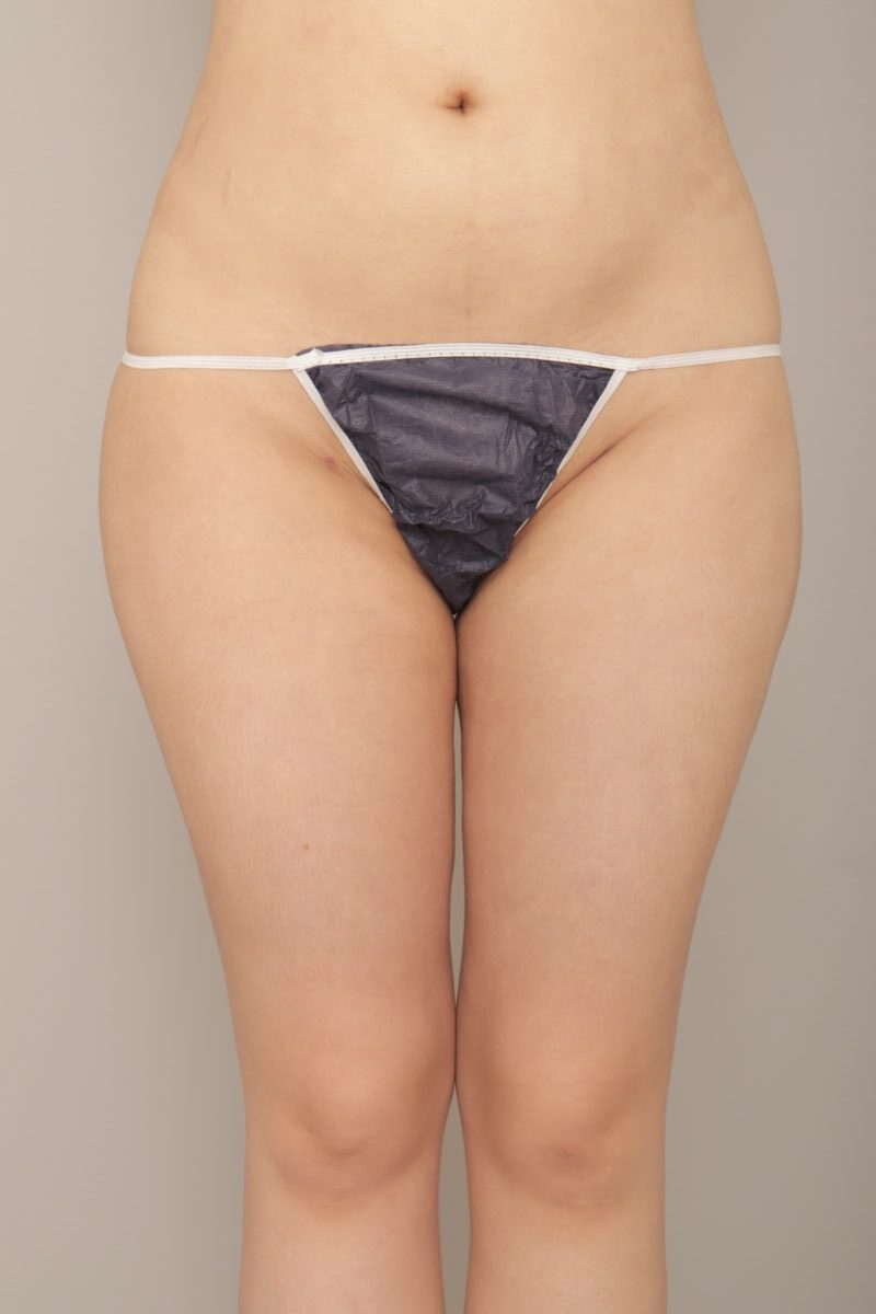 太腿脂肪吸引1ヵ月後♪ モニター様の1か月経過をご紹介♪ 24歳 155cm 59kg