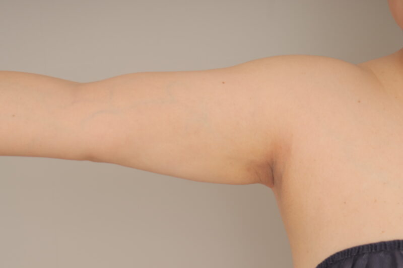 二の腕脂肪吸引6か月後♪ モニター様の6か月経過をご紹介♪ 49歳 150cm 59kg