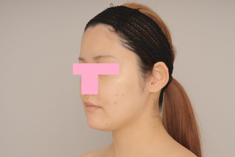 ベイザー脂肪吸引（3か月経過：21）の術前写真