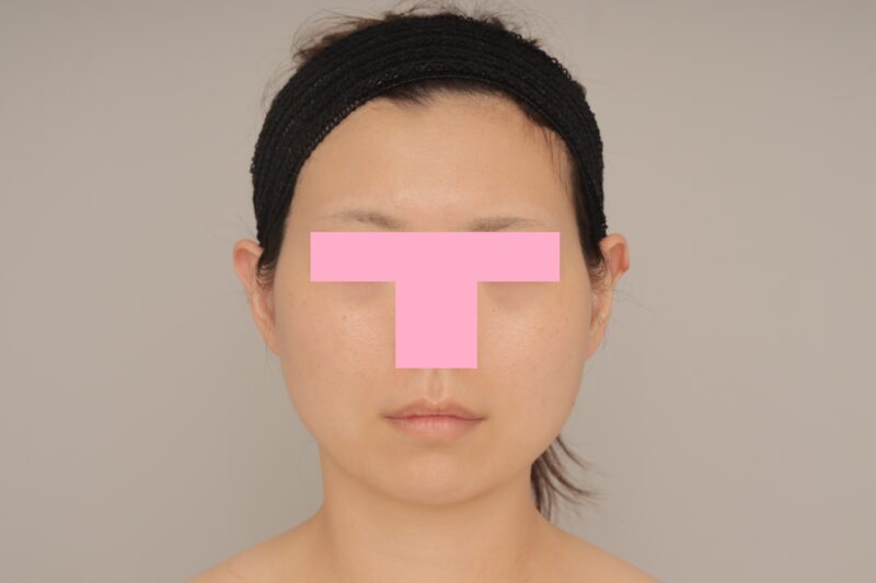 ベイザー脂肪吸引（6か月経過：31）の術前写真