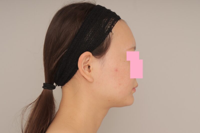 ベイザー脂肪吸引（6か月経過：25）の術前写真