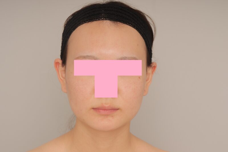 ベイザー脂肪吸引（3か月経過：25）の術前写真