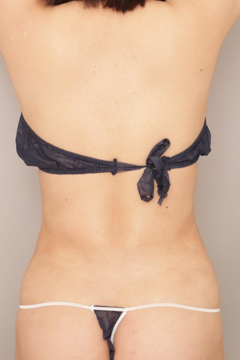 お腹と腰の脂肪吸引で美しいボディラインを作る