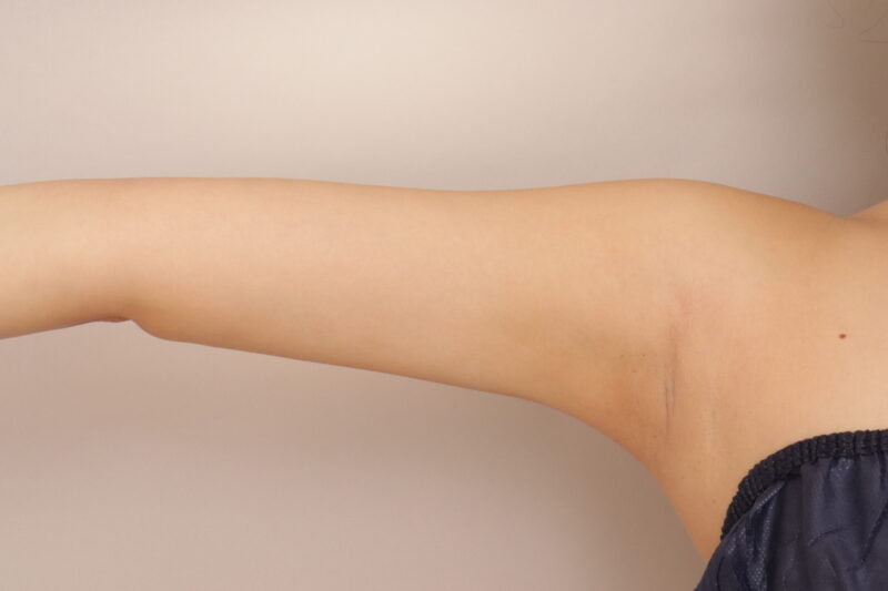 二の腕の脂肪吸引、三か月経過です