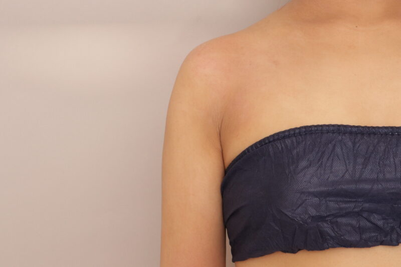 二の腕脂肪吸引、3か月経過のご紹介です