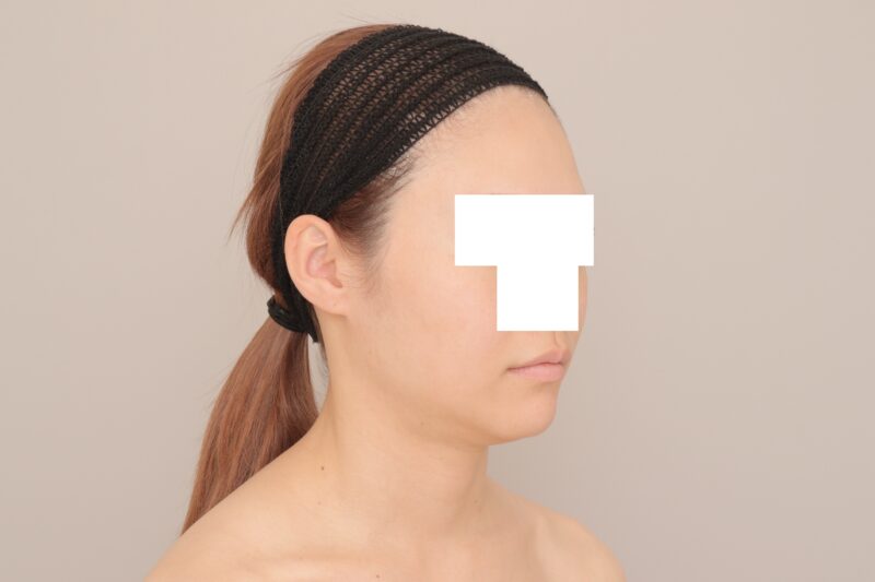 ベイザー脂肪吸引（3ヶ月経過：31）の術前写真