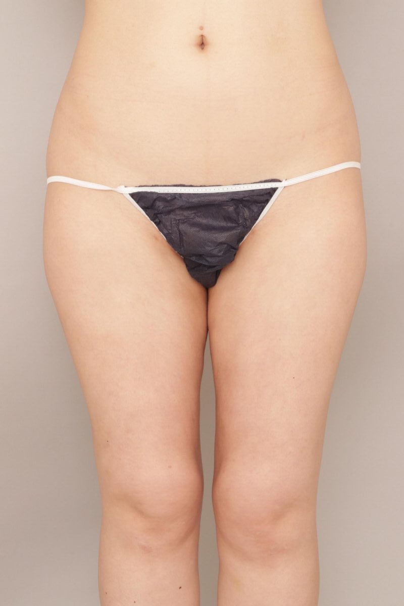 痩せても叶えられなかった美脚を脂肪吸引で