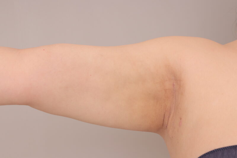 大量脂肪吸引～純脂肪2200㏄