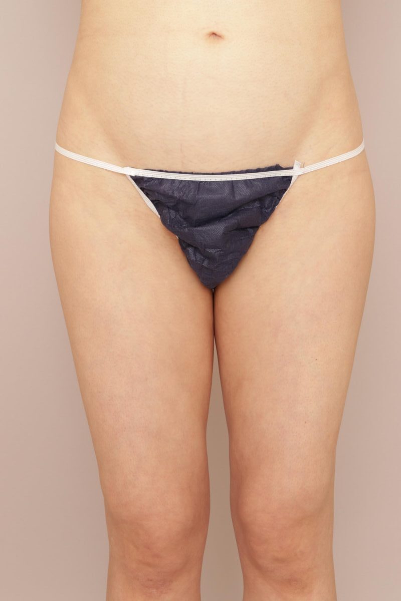 ふとももの脂肪吸引、3ヶ月経過のご紹介です