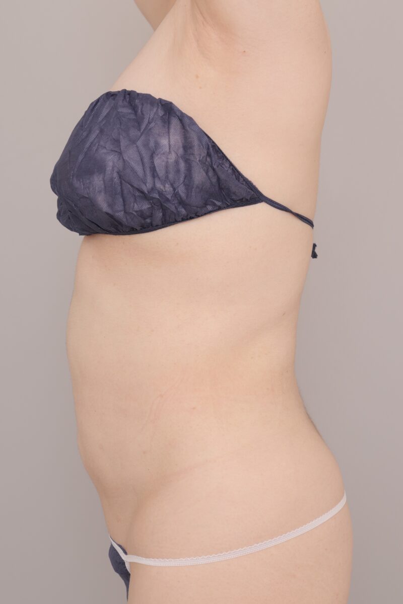 50代で4000cc大吸引！腹部＋胸下＋腰の脂肪吸引で厚みを削ぎ落とし“服選びが楽しい体型”へ