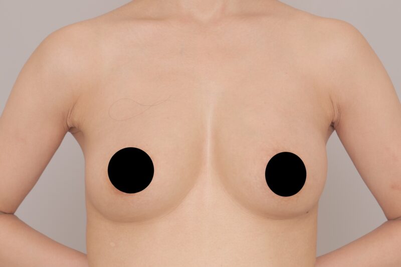 3回豊胸で、完璧なお胸に。