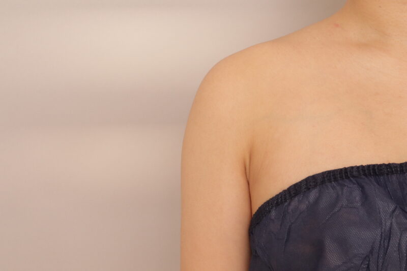 上半身を細く見せるには、二の腕の脂肪吸引がおすすめです