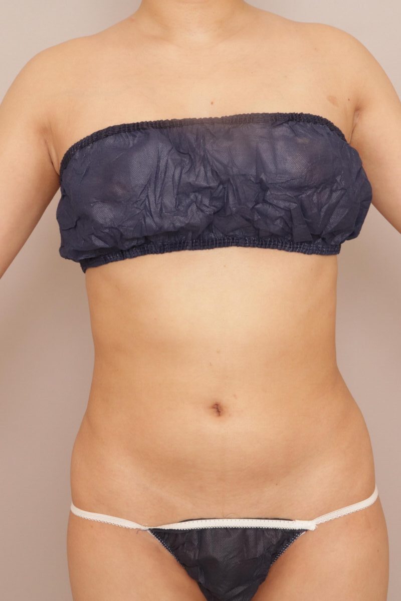 お腹と腰の脂肪吸引で、美くびれを手に入れよう！