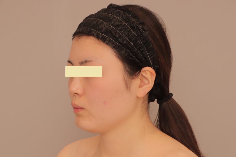 ベイザー脂肪吸引（半年経過：26）の術前写真