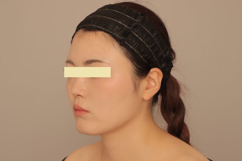 ベイザー脂肪吸引（半年経過：26）の術後写真
