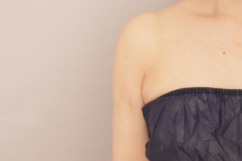 二の腕の脂肪吸引は、最高の施術です