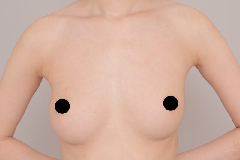“がりがり体型”でもここまで変わる！1回の脂肪豊胸で削げ感・骨ばり胸・離れ乳を全て解消