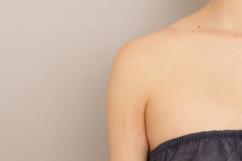 もともと細い二の腕でも、脂肪吸引なら…