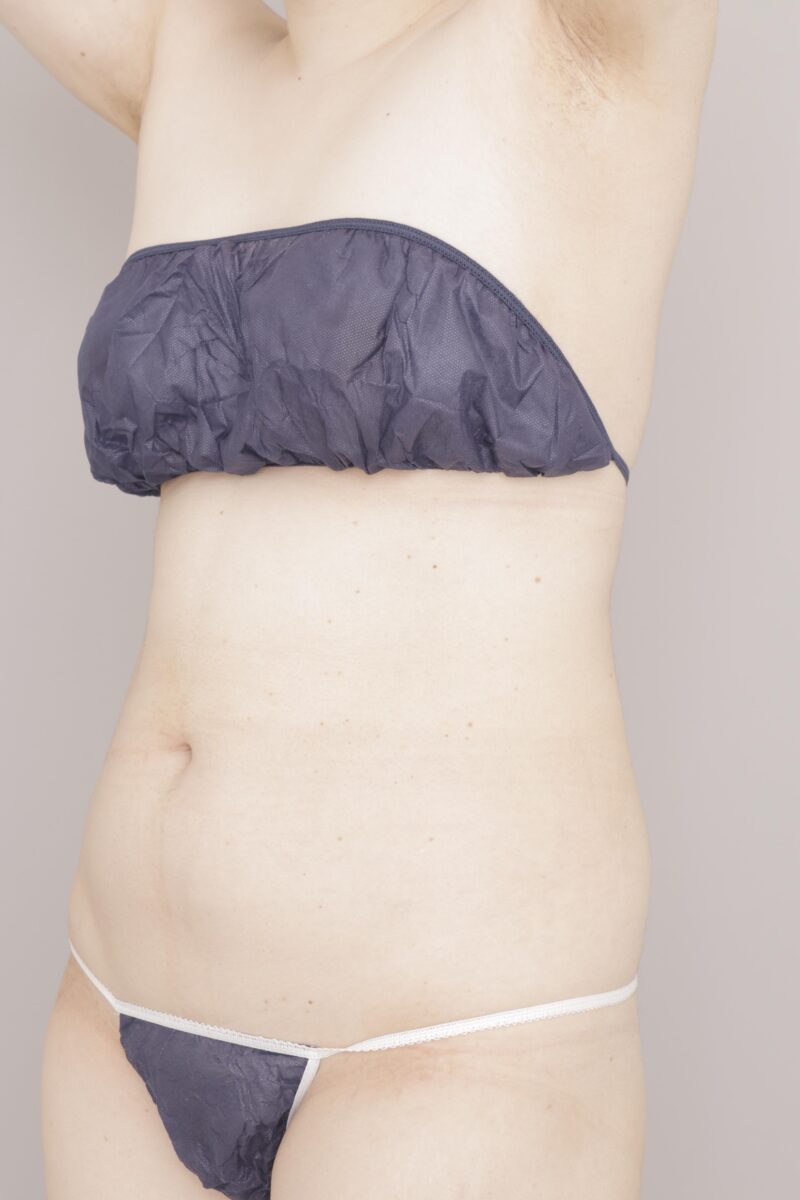 ベイザー脂肪吸引（3ヶ月経過：26）の術前写真