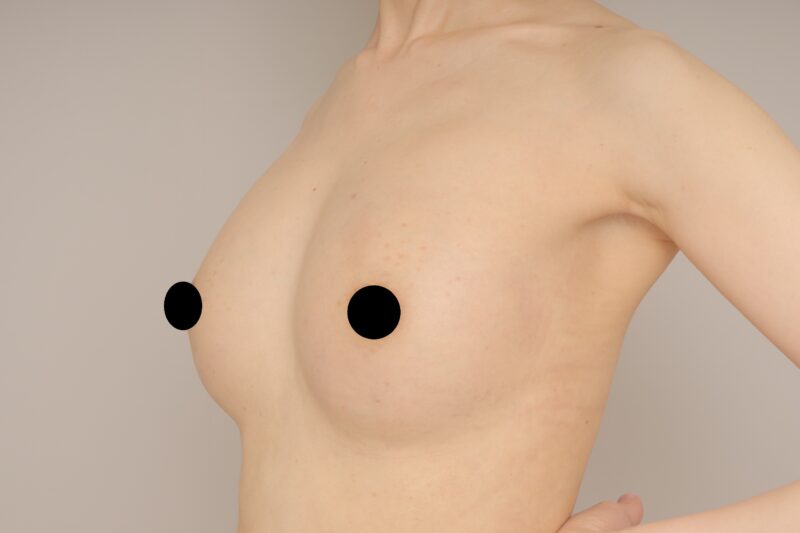 1児のママのコンデンスリッチ豊胸2回目! モニター様の1か月経過をご紹介♪ 36歳 154cm 45kg