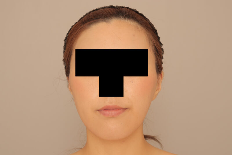 30代頬顎脂肪吸引モニター様半年後♡フェイスラインを卵型に♫