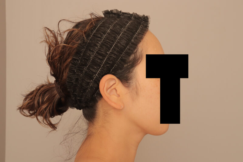 フェイスラインをシュッとさせてまっすます美人さんに♡モニター様3ヶ月後