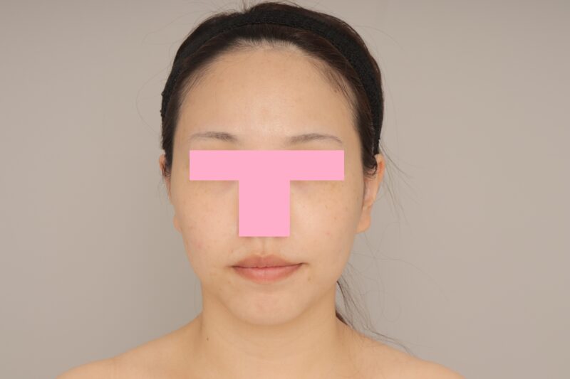 ベイザー脂肪吸引（6か月経過：30）の術前写真