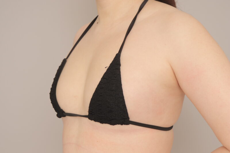 コンデンスリッチ豊胸で美しいバストに♪ モニター様の1か月経過をご紹介♪ 31歳 160cm 61kg