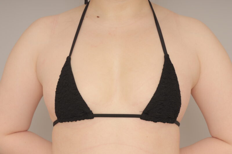 コンデンスリッチ豊胸3ヵ月後♪ モニター様の3か月経過をご紹介♪ 31歳 160cm 61kg