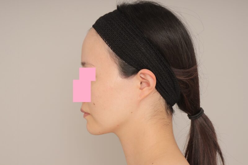 ウェディングも任せて♪ モニター様の6か月経過をご紹介♪ 29歳 157cm 50kg