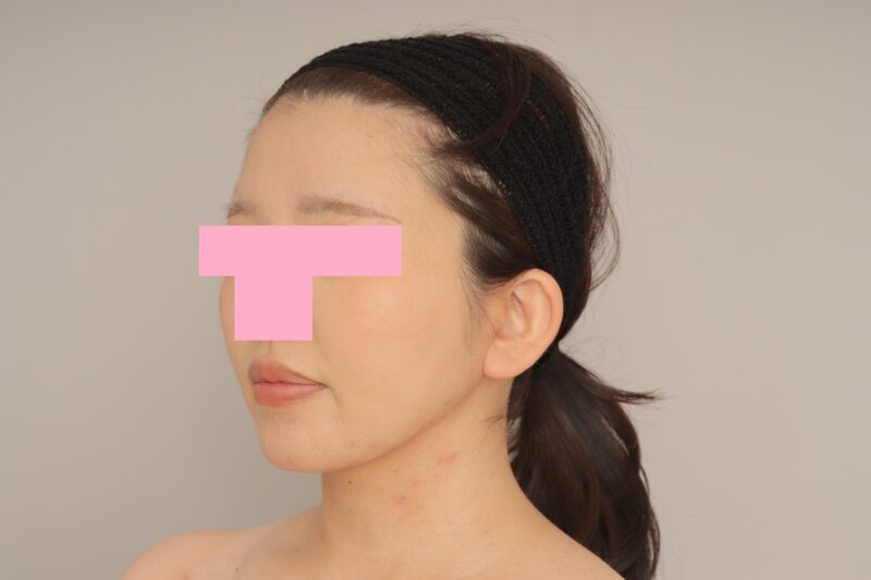 ベイザー脂肪吸引(6か月経過:25)の術後写真