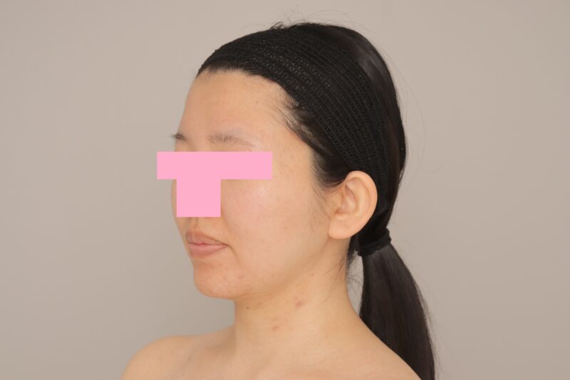 ベイザー脂肪吸引(6か月経過:25)の術前写真