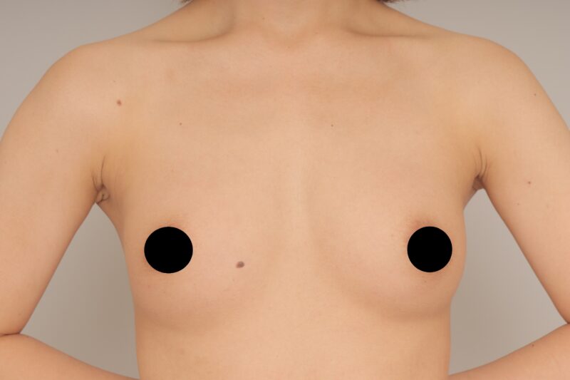 コンデンスリッチ豊胸1回でこんなに♪ モニター様の3か月経過をご紹介♪ 33歳 158cm 46kg