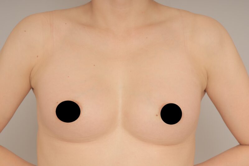 ベイザー脂肪吸引(1ヵ月経過:44)の術後写真