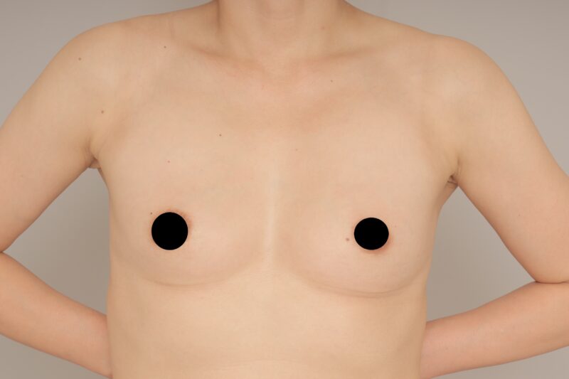 ベイザー脂肪吸引(1ヵ月経過:44)の術前写真