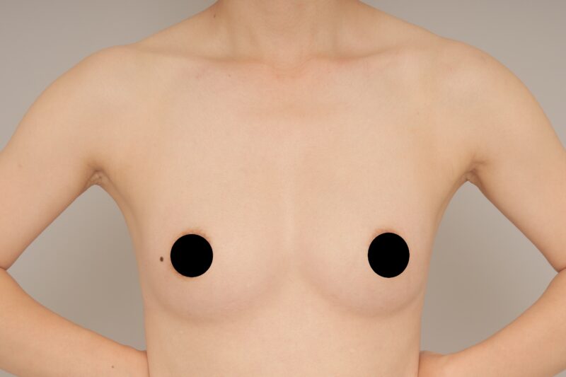 ナースさんのコンデンスリッチ豊胸！　モニター様の1か月経過をご紹介♪　40歳 153cm 40kg