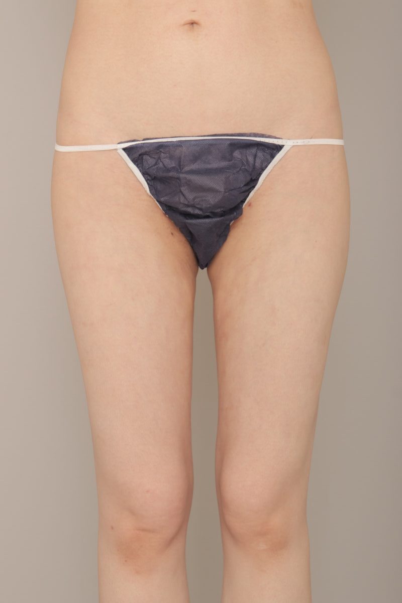 細身の方の太腿脂肪吸引! モニター様の1か月経過をご紹介♪ 40歳 153cm 40kg