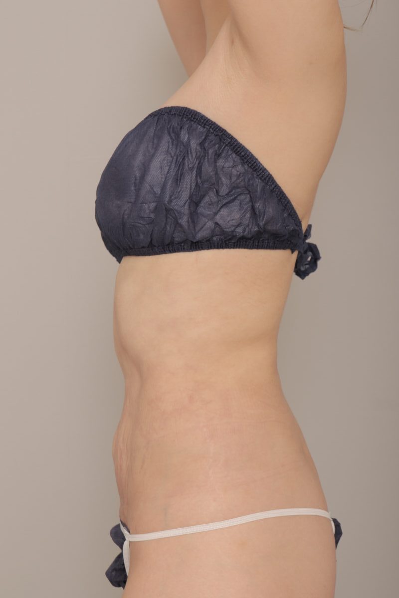 ベイザー脂肪吸引(1ヵ月経過:43)の術後写真