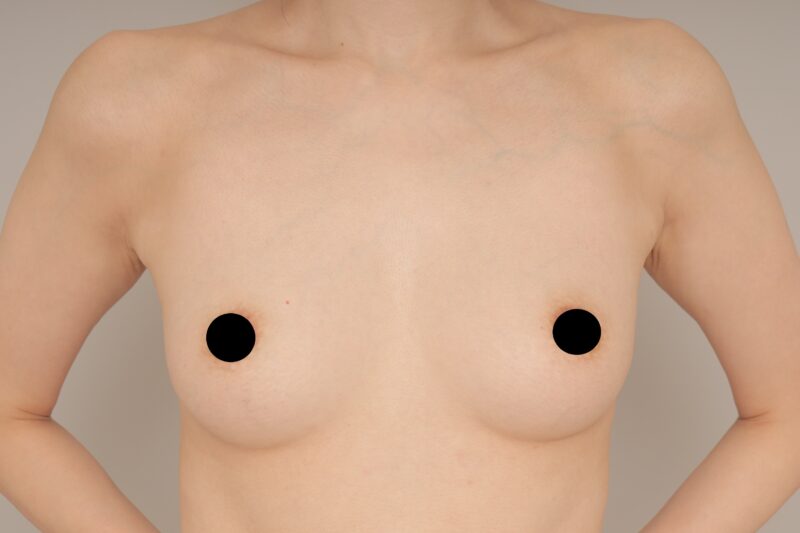 ベイザー脂肪吸引（3か月経過：43）の術前写真