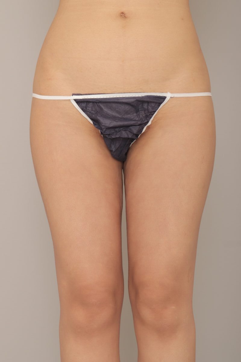 太腿脂肪吸引で更に細く! モニター様の1か月経過をご紹介♪ 28歳 158cm 52kg